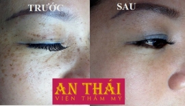 Cách chăm sóc da bị nám trong mùa lạnh