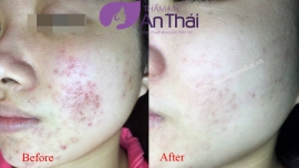 Trẻ hóa da Laser Toning & Than hoạt tính