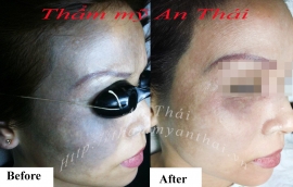 Cách xóa sạch chàm, bớt bẩm sinh an toàn, không để lại sẹo