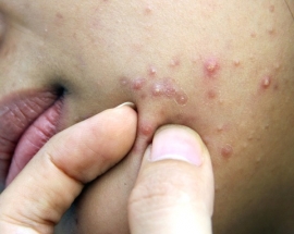 Trị mụn tận gốc, siêu nhanh, không tái phát hiệu quả nhất 2015