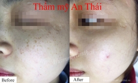 Khách hàng nhận xét dịch vụ xóa tàn nhang (P1)