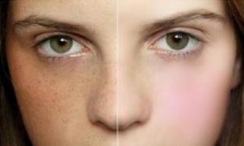 Quy trình trị tàn nhang