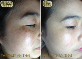 Giải pháp trị tàn nhang triệt để 1 lần duy nhất