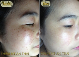 Trị tàn nhang -11