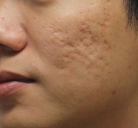 Lời khuyên của bác sĩ cho bạn bị sẹo lõm