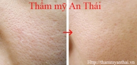 Se khít, thu nhỏ lỗ chân lông bằng công nghệ mới