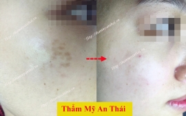 Tự tin xóa sạch nám tại Thẩm mỹ An Thái