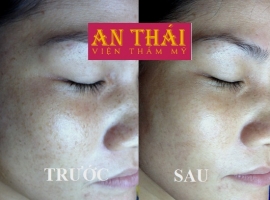 Giải pháp trị nám cho người bận rộn