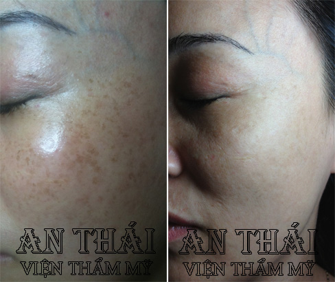 Trị tàn nhang tận gốc tại TM An Thái 04