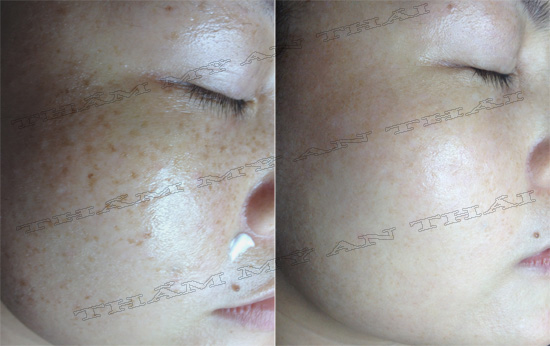 Trị tàn nhang tận gốc tại TM An Thái 03