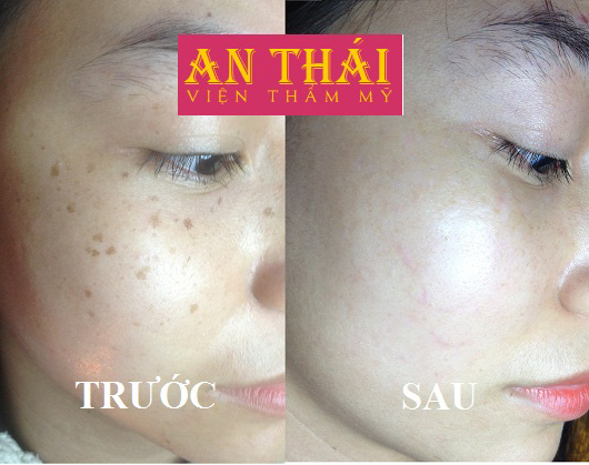 Trị tàn nhang tận gốc tại TM An Thái 05