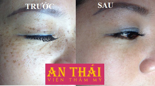 Trị tàn nhang tận gốc tại Thẩm mỹ An Thái 08